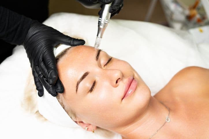 The Glow-Back Treatment: Why Microneedling Is Becoming Popular in Canberra